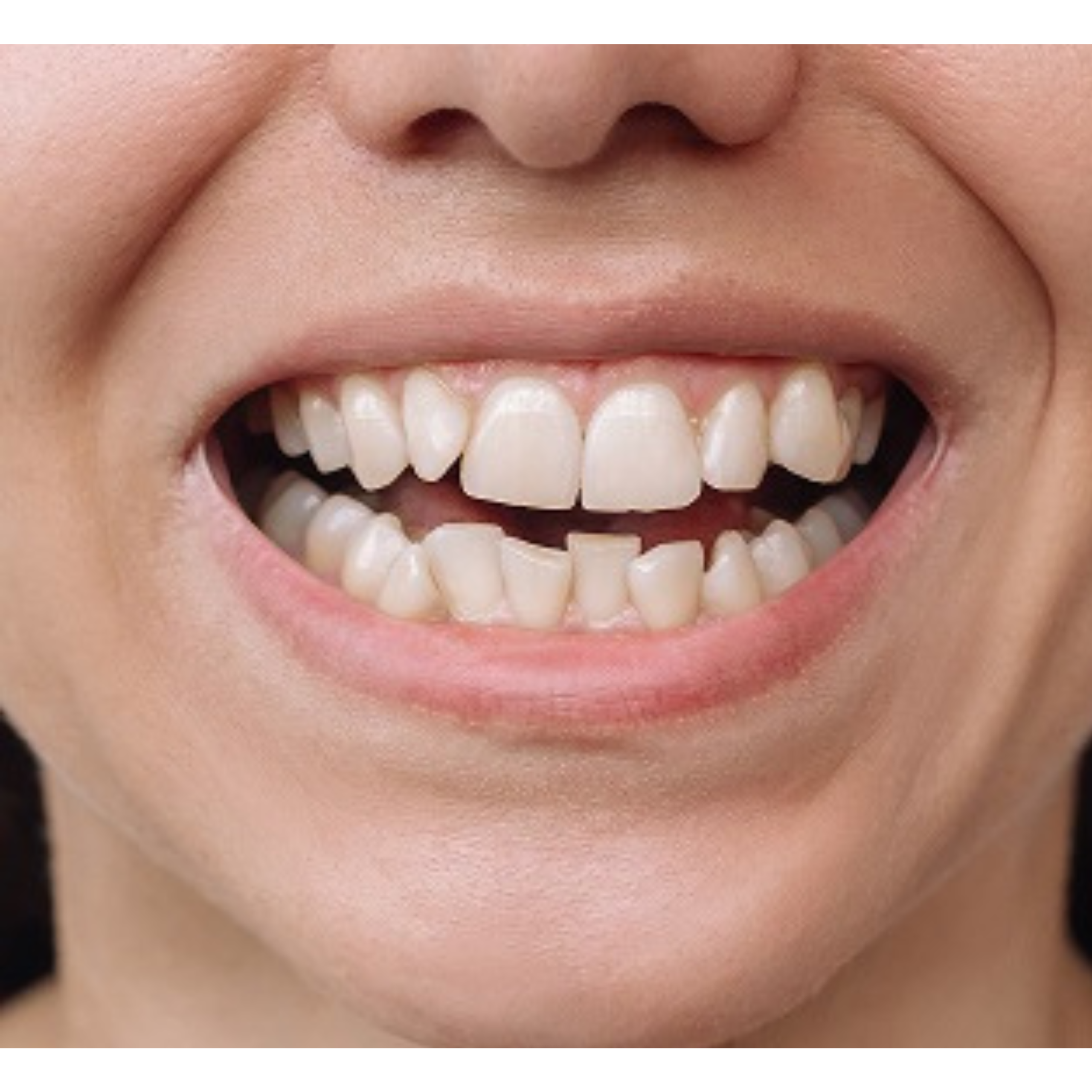 Clear Aligners | KPS Dentalcare