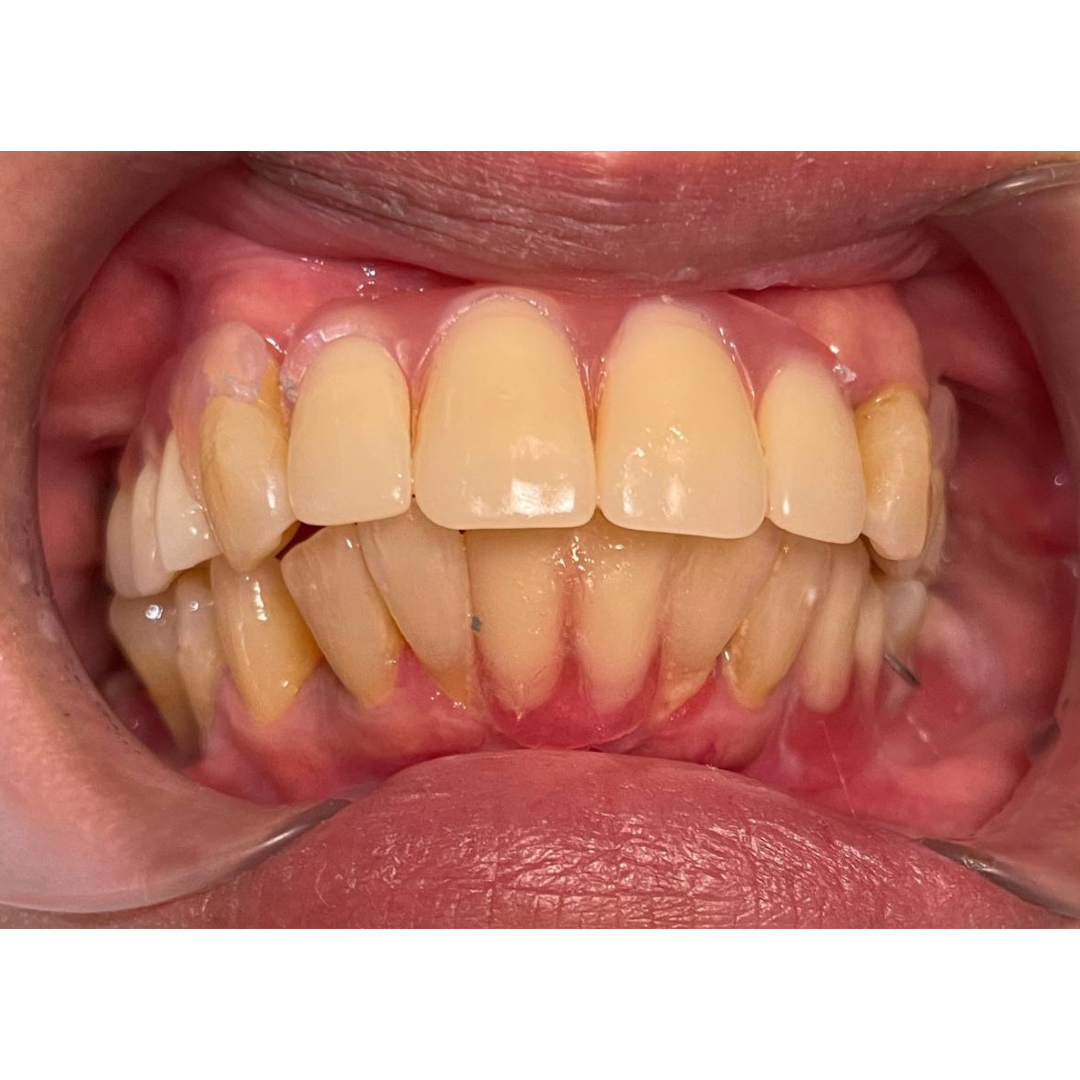 Acrylic, Flexible & Chrome Cobalt Dentures for Natural Smile – After Denture | KPS Dentalcare