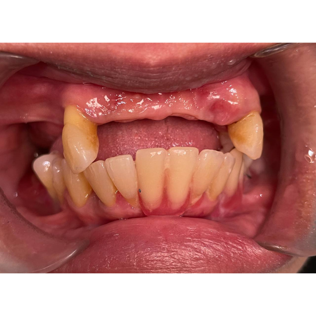 Acrylic, Flexible & Chrome Cobalt Dentures for Natural Smile – Before Denture | KPS Dentalcare