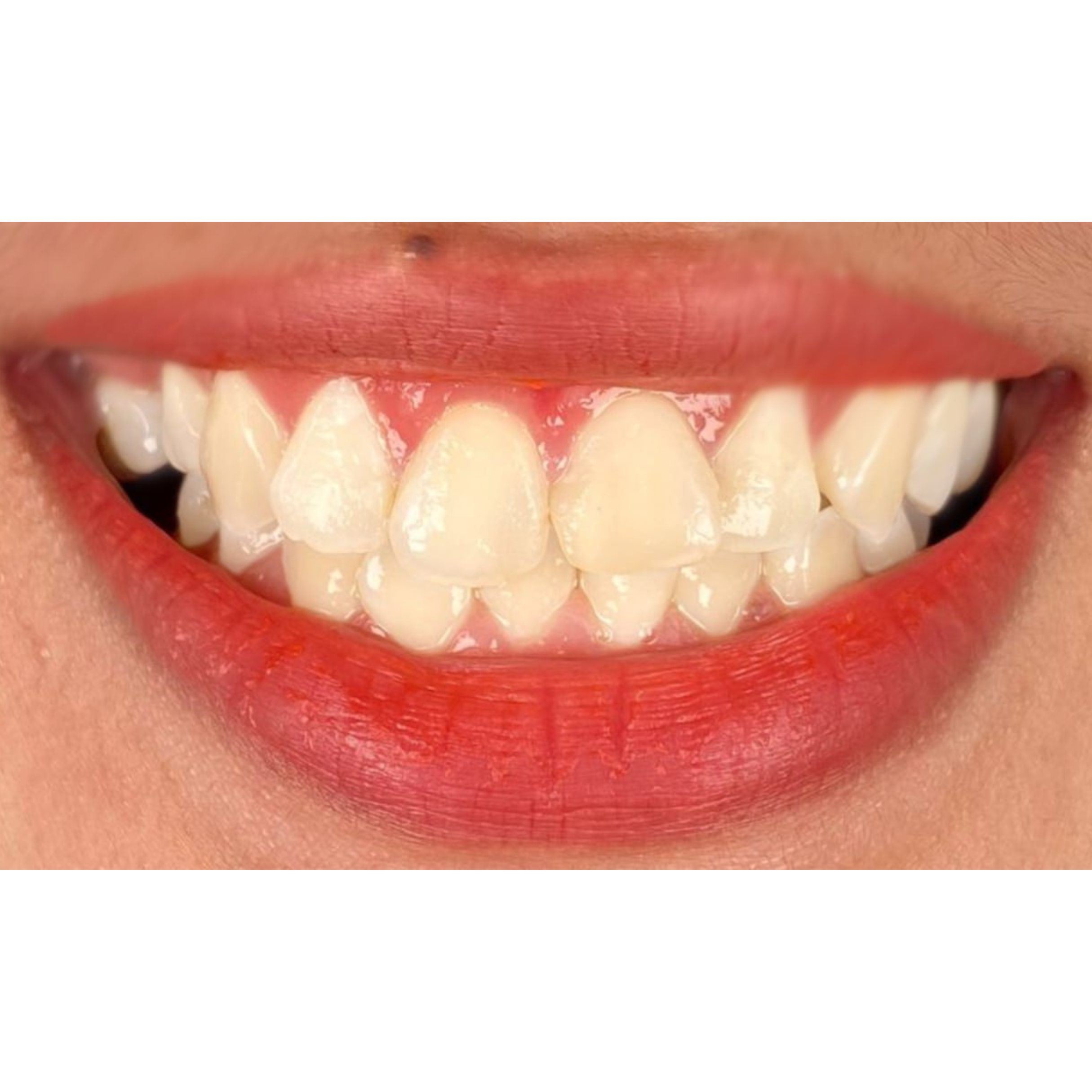 Smile Makeover – Gummy Smile | KPS Dentalcare