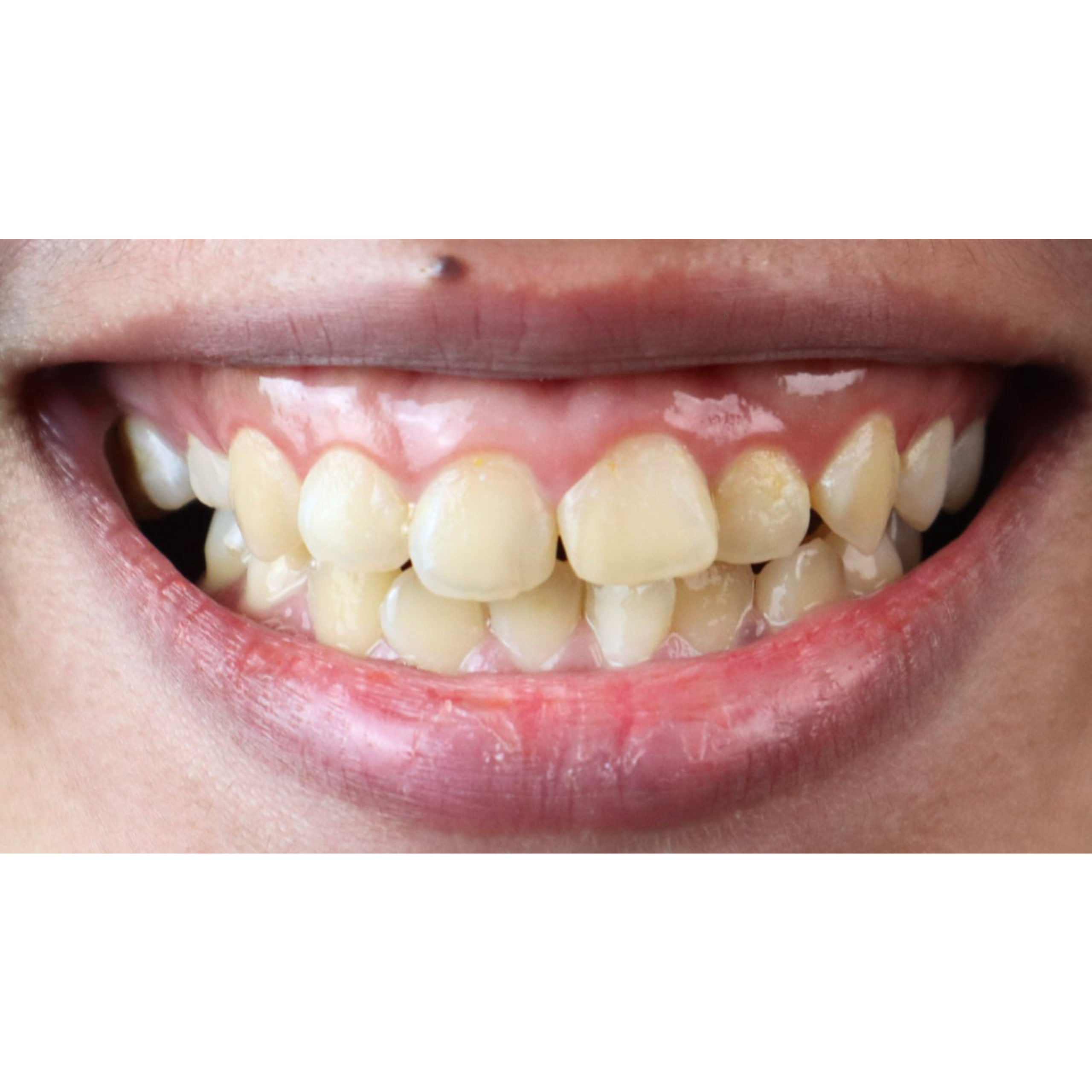 Smile Makeover – Gummy Smile | KPS Dentalcare