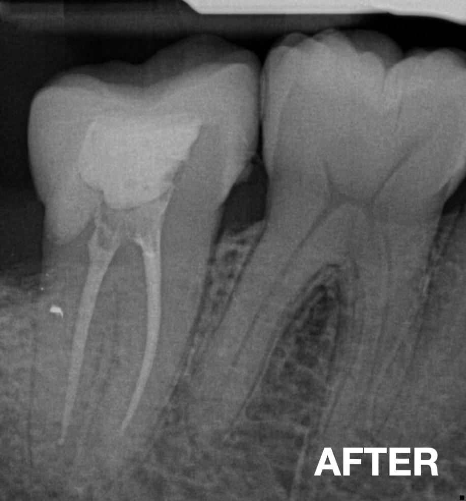 Root Canal Treatment (RCT) After | KPS Dentalcare