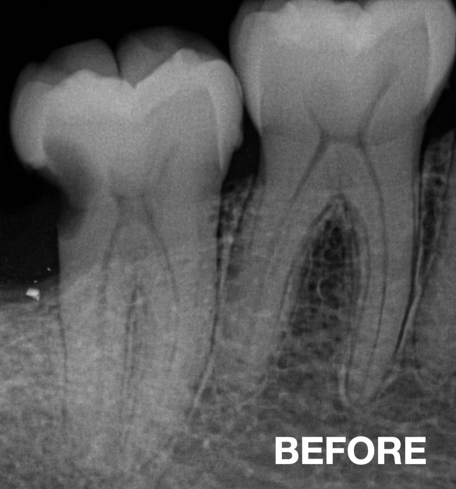 Root Canal Treatment (RCT) Before | KPS Dentalcare