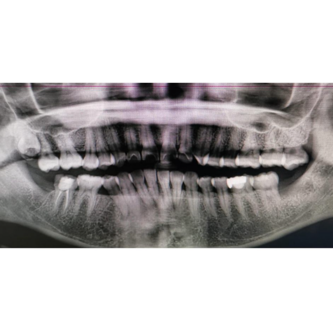 Minor Oral Surgery | KPS Dentalcare