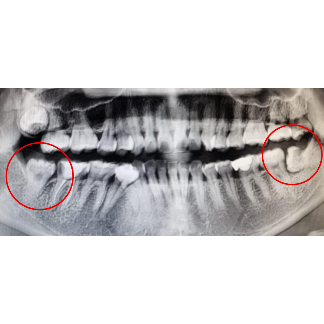 Minor Oral Surgery | KPS Dentalcare