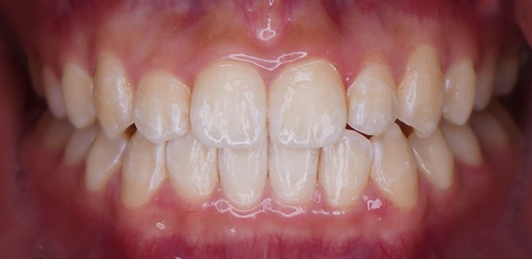 Retainer Teeth | KPS Dentalcare