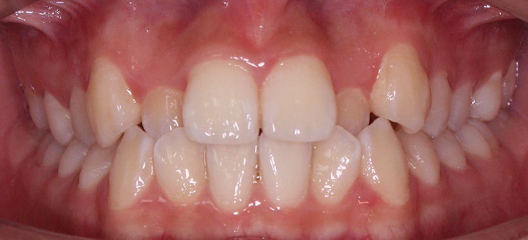 Retainer Teeth | KPS Dentalcare