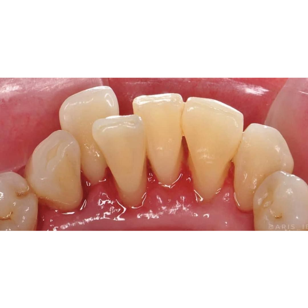 Scaling | KPS Dentalcare