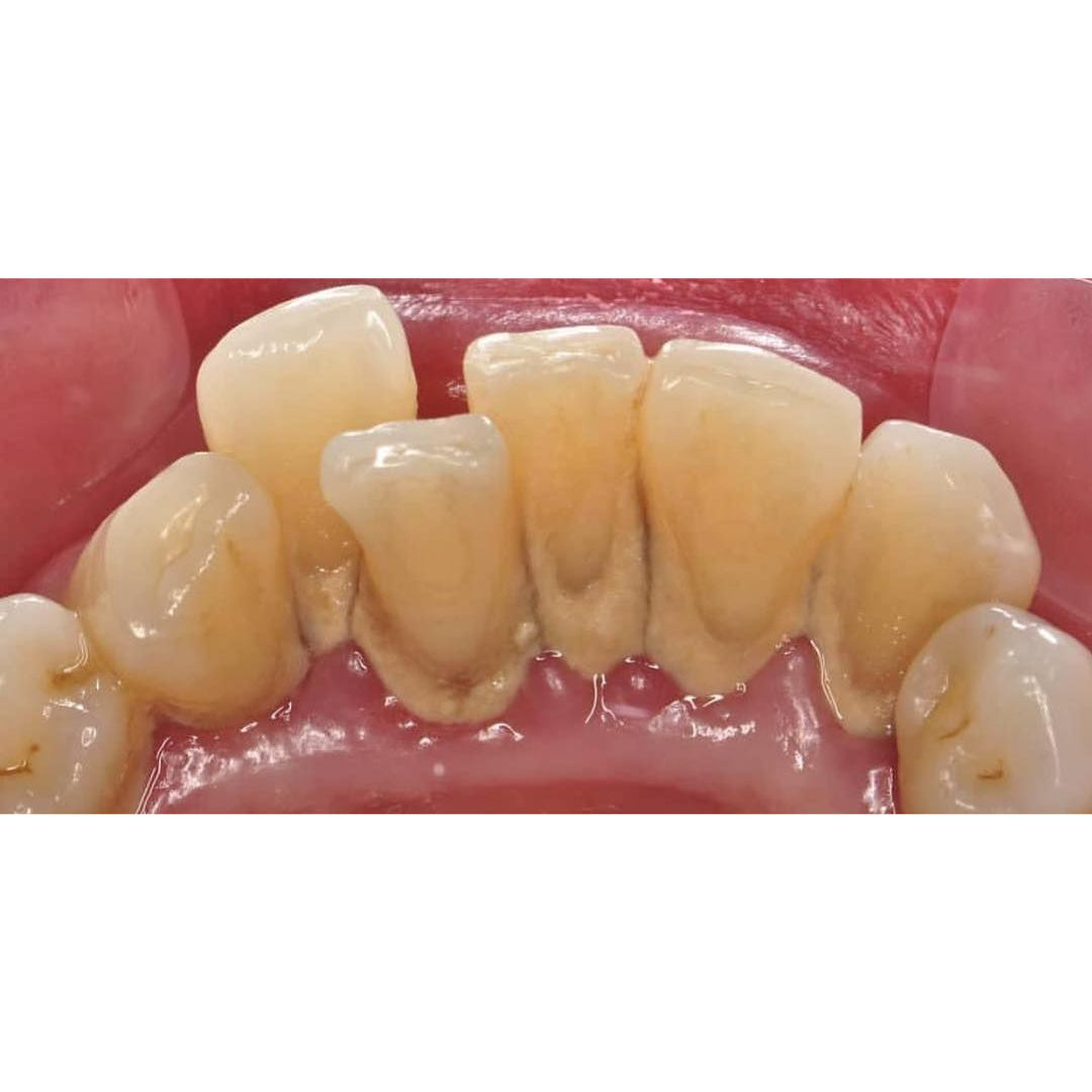 Scaling | KPS Dentalcare