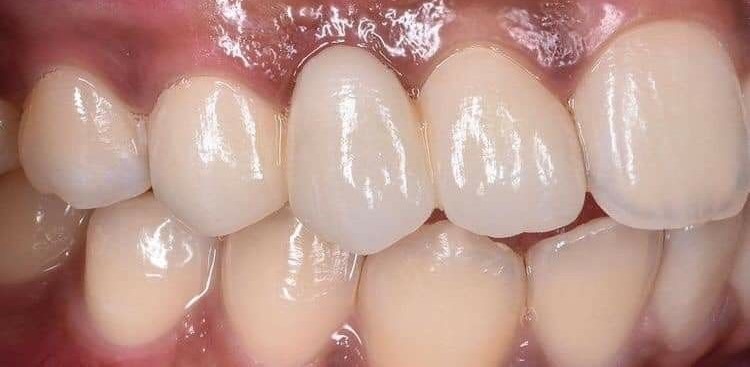 Bridge For Teeth Helps Replace Missing Teeth Naturally. Explore Maryland, Cantilever & Traditional Dental Bridges For A Confident Smile - After| KPS Dentalcare