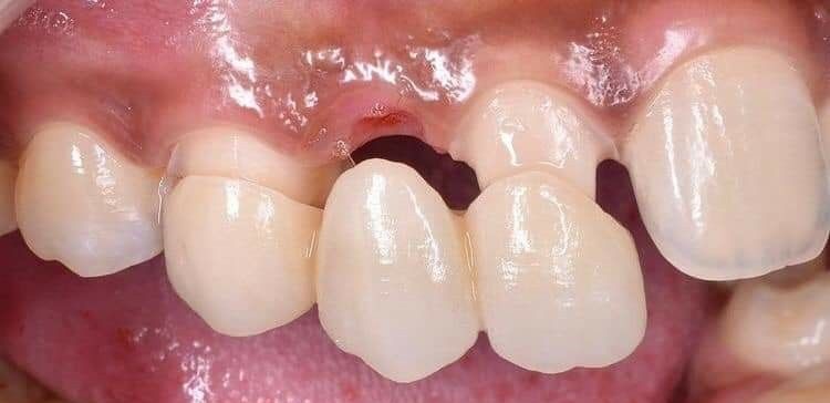 Bridge For Teeth Helps Replace Missing Teeth Naturally. Explore Maryland, Cantilever & Traditional Dental Bridges For A Confident Smile - Before | KPS Dentalcare