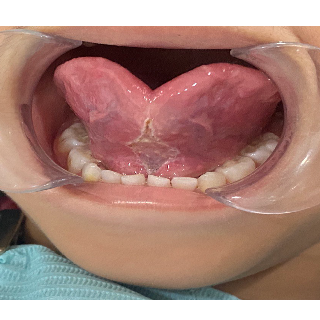 Laser Electrocautery Treatment for Tongue Tie - After | KPS Dentalcare