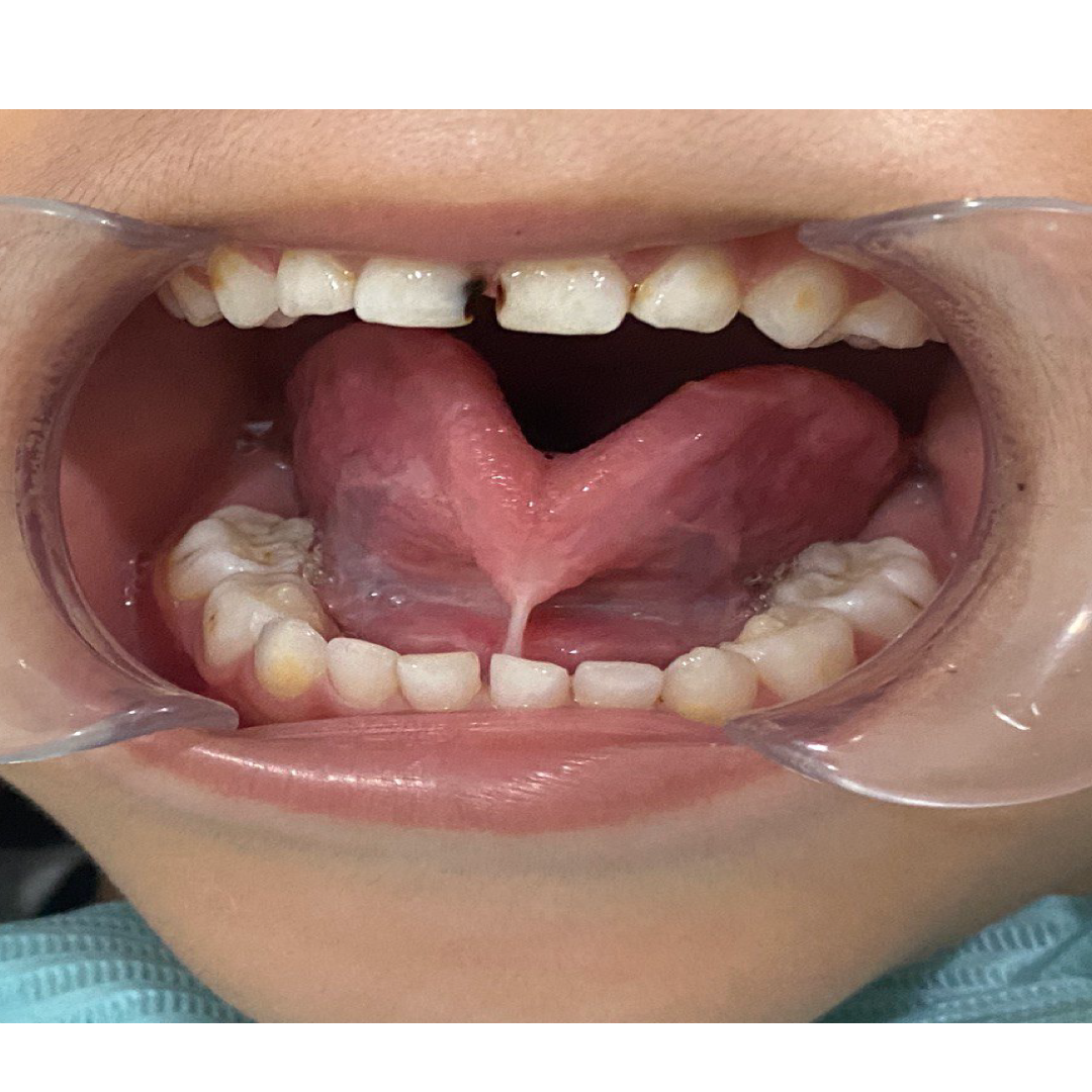 Laser Electrocautery Treatment for Tongue Tie - Before | KPS Dentalcare