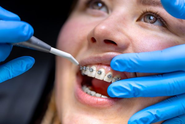 Braces Dental – Types & Benefits | KPS Dentalcare