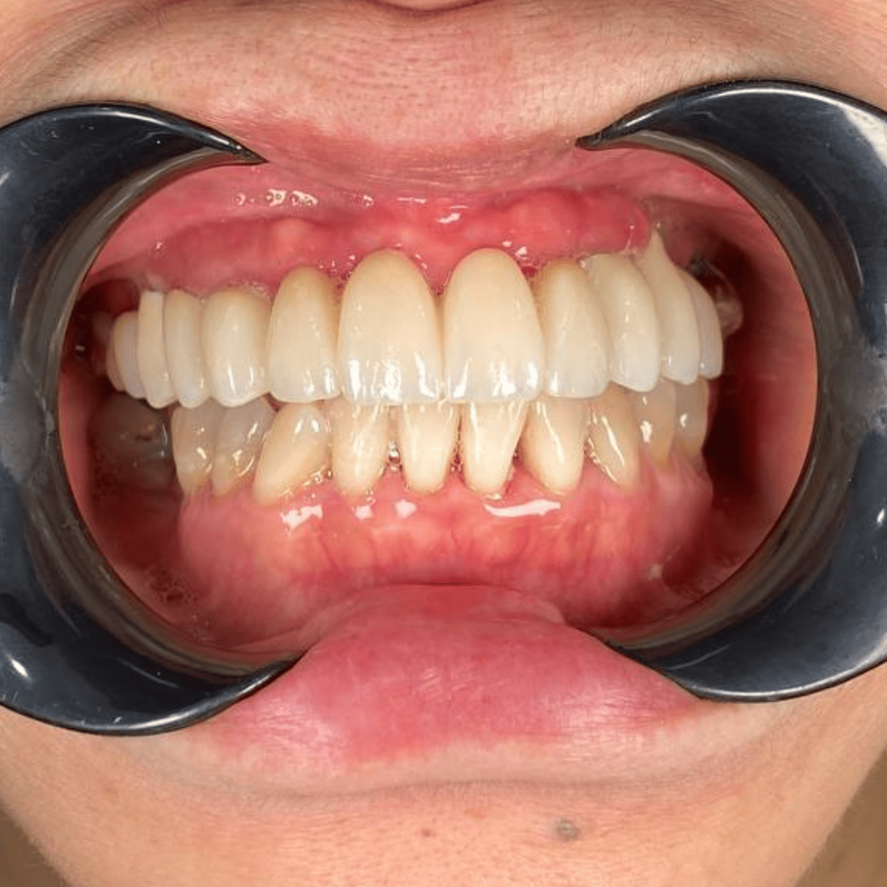 Dental Implant - After Single | KPS Dentalcare