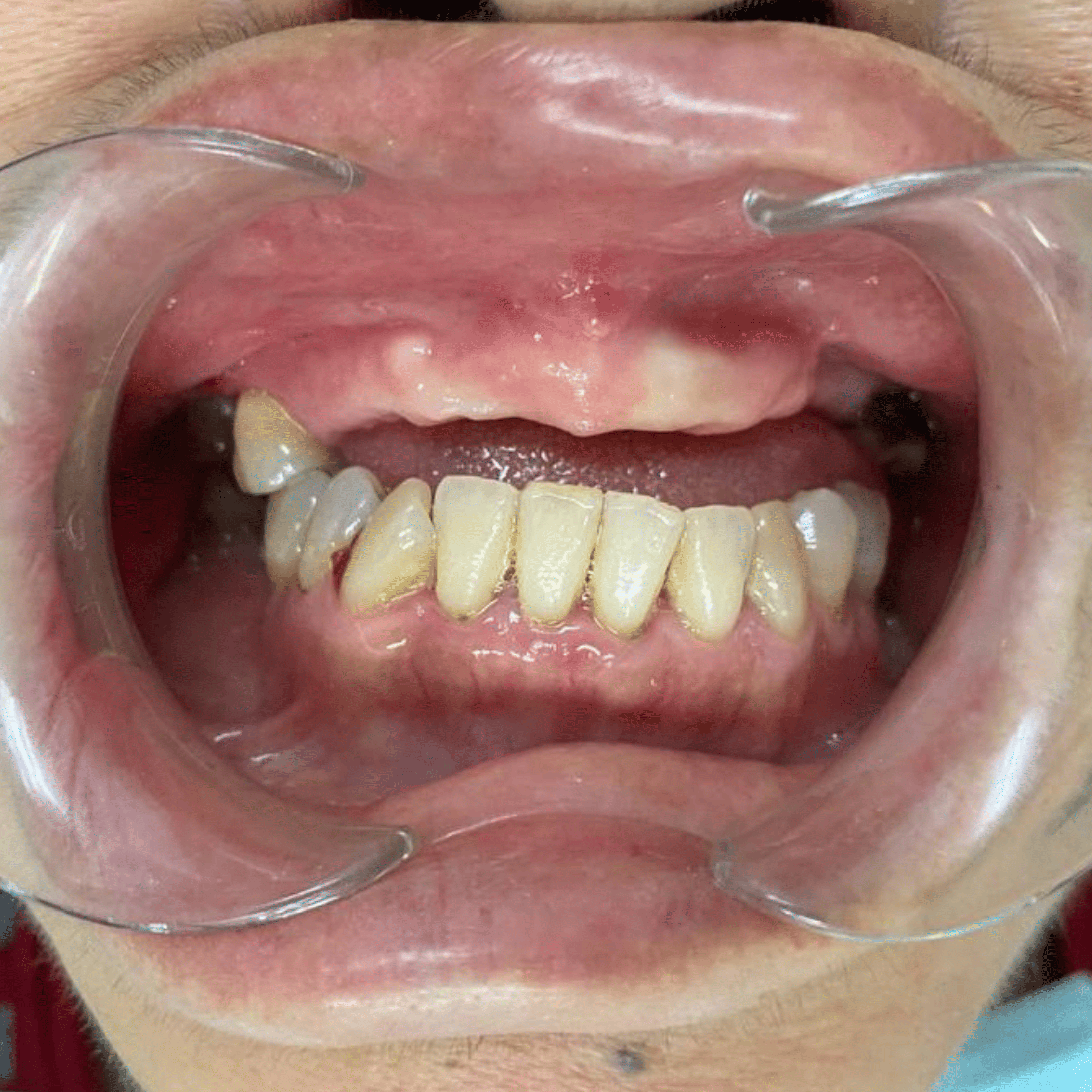 Dental Implant - Before All-on-6 | KPS Dentalcare