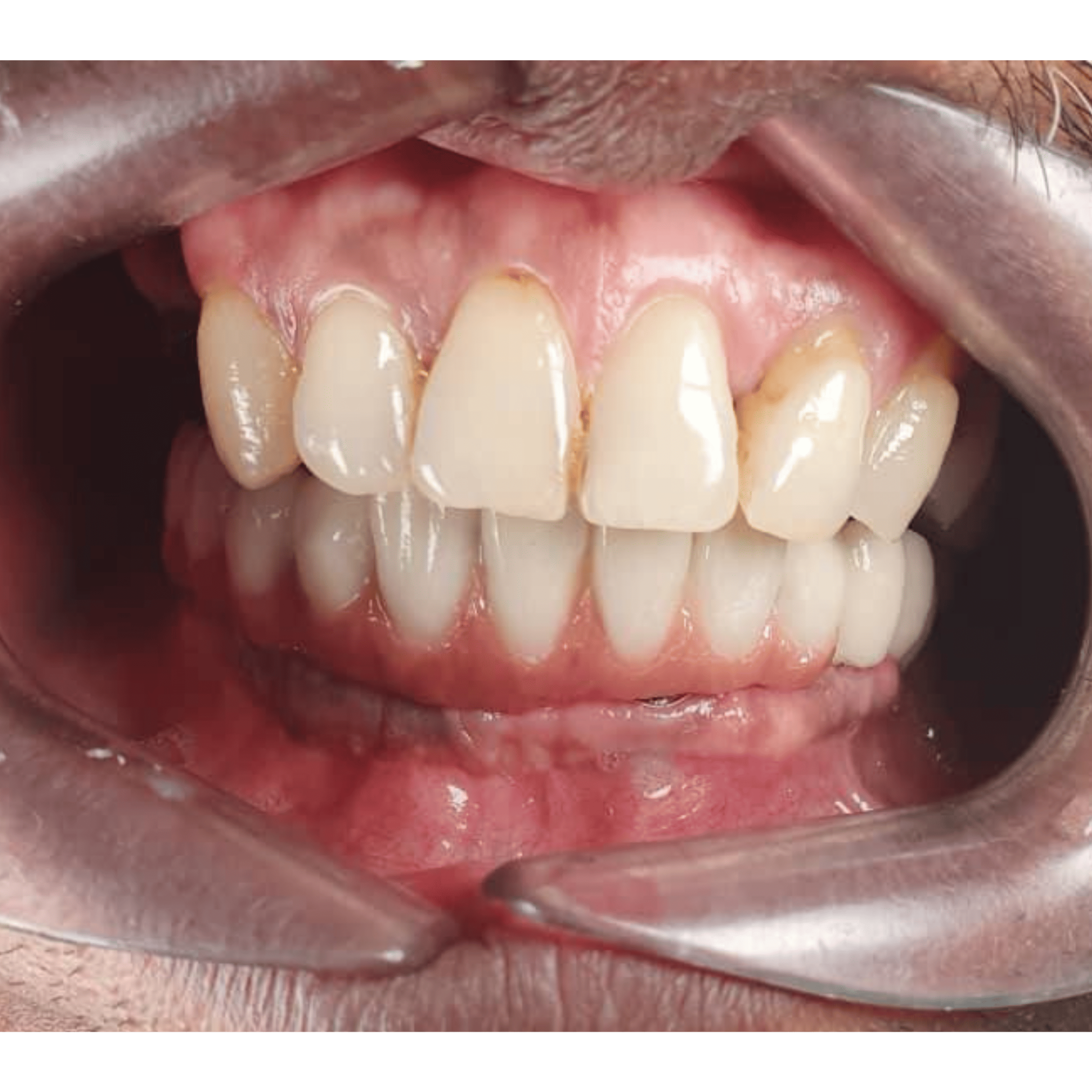 Dental Implant - Multiple Teeth Missing - After | KPS Dentalcare