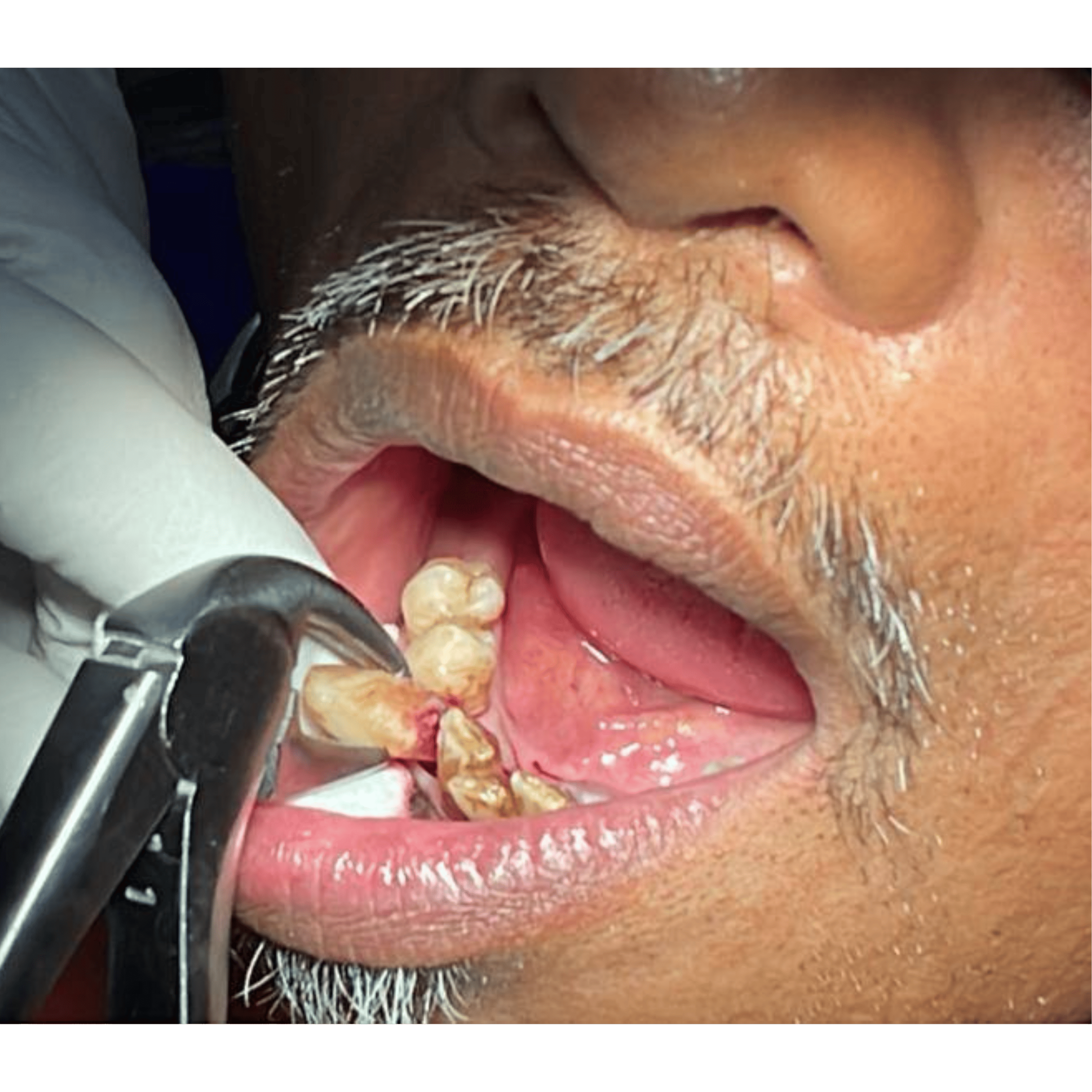 Dental Implant - Multiple Teeth Missing - Before | KPS Dentalcare