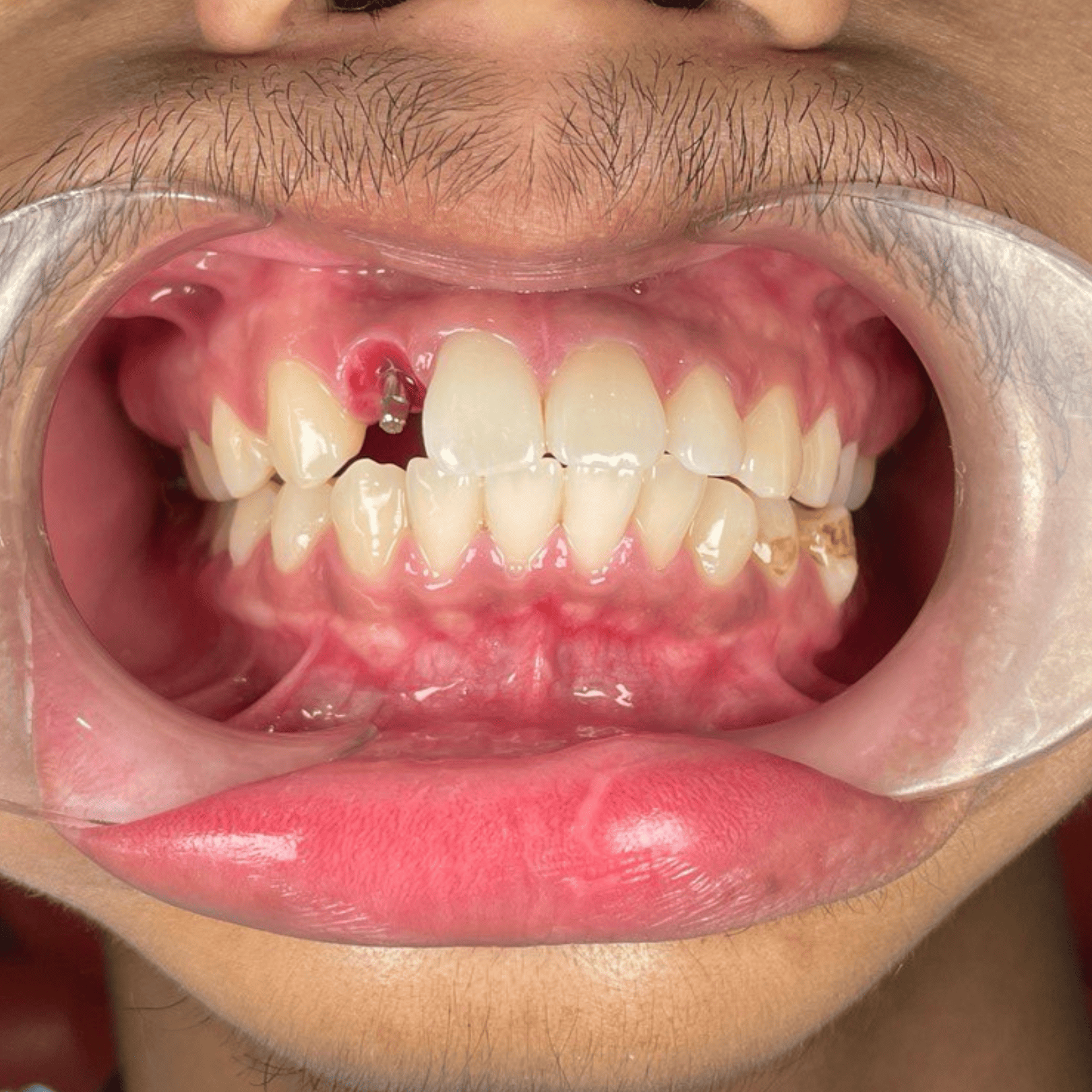 Dental Implant - Before Single | KPS Dentalcare