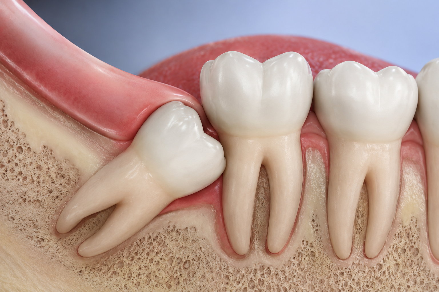 Gigi Bongsu Tumbuh Senget Punca & Rawatan KPS Dental Care
